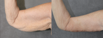 Arm Lift before and after photo