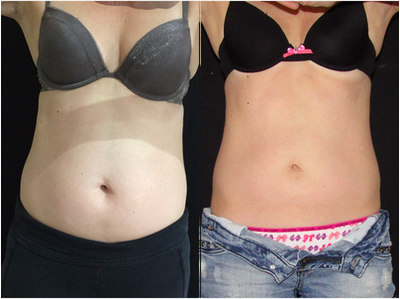 CoolSculpting before and after photo