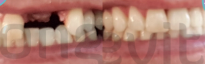 Dental Implants before and after photo