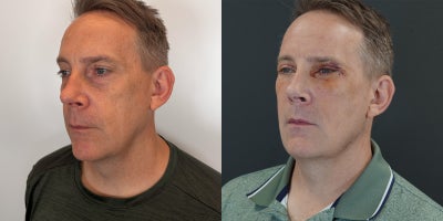 Eyelid Surgery before and after photo