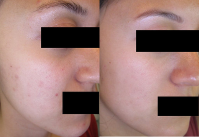 Laser Genesis before and after photo