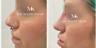 Nonsurgical Nose Job before and after photo