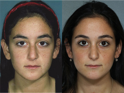 Revision Rhinoplasty before and after photo