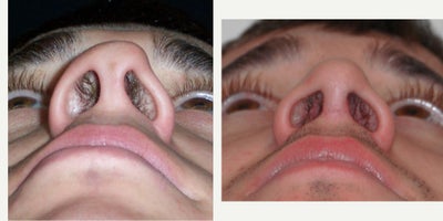Revision Rhinoplasty before and after photo