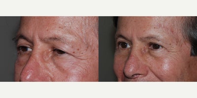 Brow Lift before and after photo