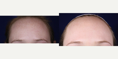 Fractional Laser before and after photo
