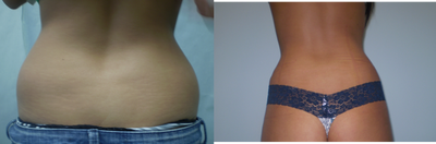 Liposuction before and after photo