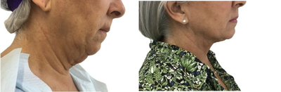 Nonsurgical Neck Lift before and after photo