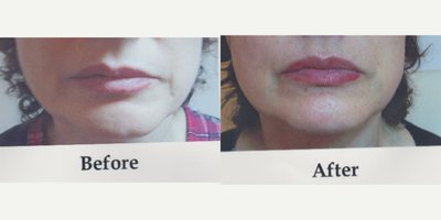 Skin Tightening before and after photo