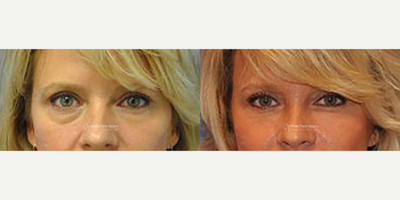 Belotero before and after photo