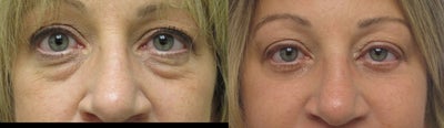 CO2 Laser before and after photo