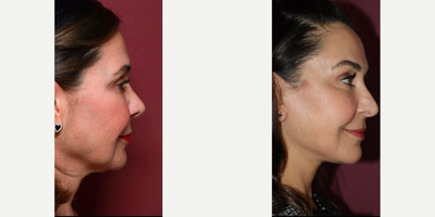 Deep Plane Facelift before and after photo