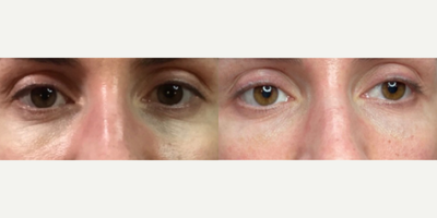 Dermal Fillers before and after photo