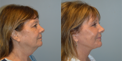Facelift before and after photo