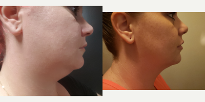 Dermal Fillers before and after photo