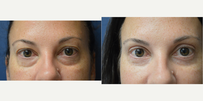 Eyelid Surgery before and after photo