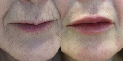 Juvederm before and after photo