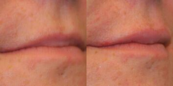Juvederm before and after photo