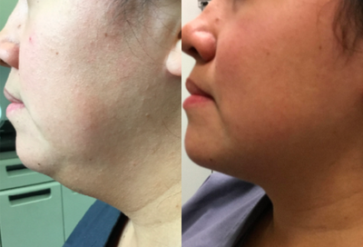 Kybella before and after photo