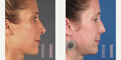 Revision Rhinoplasty before and after photo