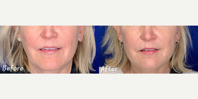 Skin Rejuvenation before and after photo
