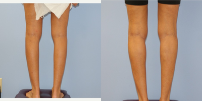 Calf Implant before and after photo