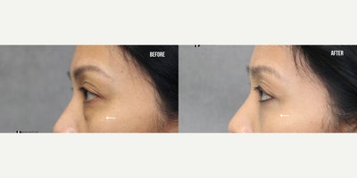Eyelid Surgery before and after photo