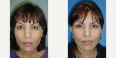 Facelift before and after photo