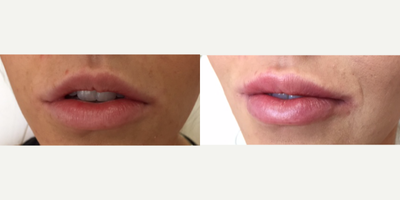 Juvederm before and after photo