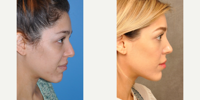Rhinoplasty before and after photo