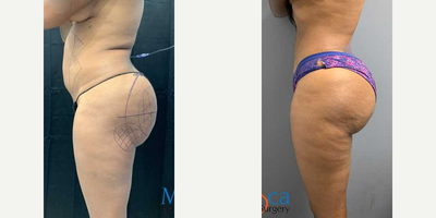 Abdominal Etching before and after photo