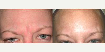Botox before and after photo