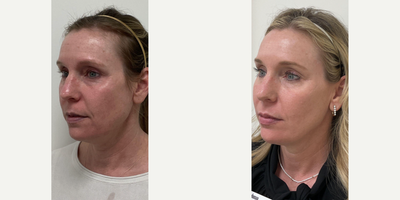 Botox before and after photo