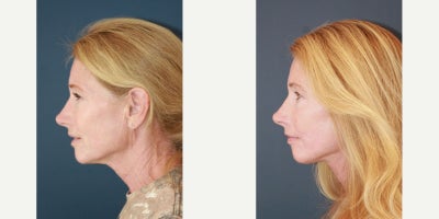 Facelift before and after photo