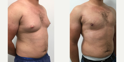 Laser Liposuction before and after photo