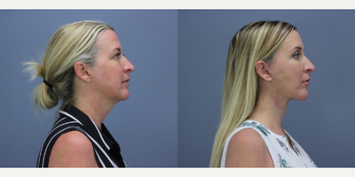 Lower Facelift before and after photo