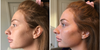 Restylane Lyft before and after photo