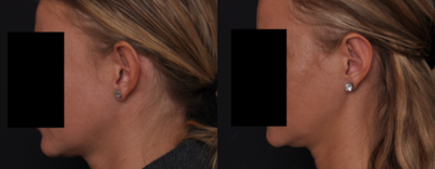 Ear Surgery before and after photo