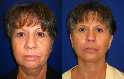 Facelift before and after photo