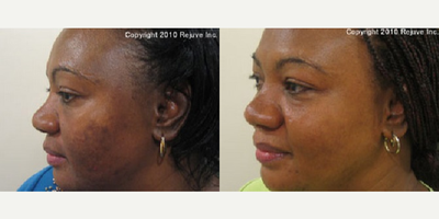Laser Resurfacing before and after photo