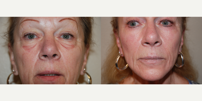 Skin Rejuvenation before and after photo