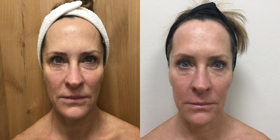 Halo Laser before and after photo