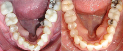Invisalign before and after photo