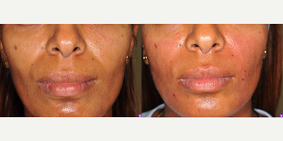Juvederm before and after photo