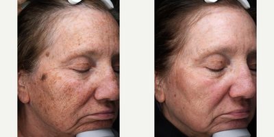 Laser Resurfacing before and after photo
