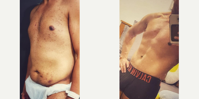 Liposculpture before and after photo
