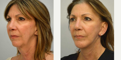 Lower Facelift before and after photo