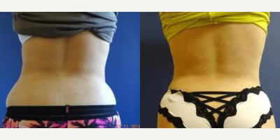 SculpSure before and after photo