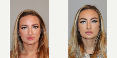 Brow Lift before and after photo