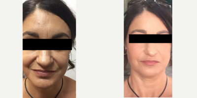 Dermal Fillers before and after photo